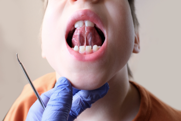 Frenectomy: Ask A Pediatric Dentist About Newborn Lip And Tongue Tie